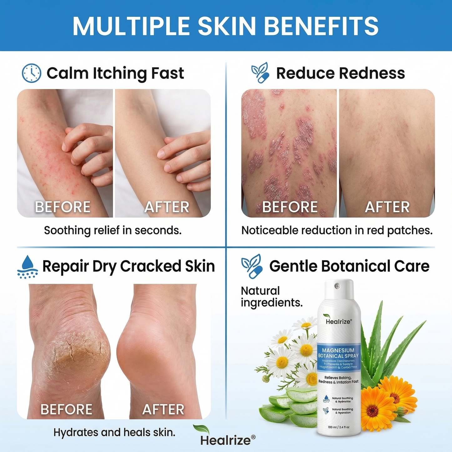 🎉Special limited-time discount | Healrize® Magnesium Botanical Spray – Advanced Skin Recovery for Psoriasis & Eczema | Rapid Soothing, Steroid-Free🚀Global Shipping