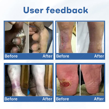 Healrize®  DiabeticFoot UicerHealing Cream