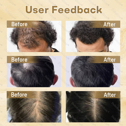 Best Seller🔥 Healrize® Hair Regrowth Capsules, Newly Upgraded,Nano Penetration, Deep into Hair Roots🎉𝙇𝙞𝙢𝙞𝙩𝙚𝙙-𝙏𝙞𝙢𝙚 𝙊𝙛𝙛𝙚𝙧