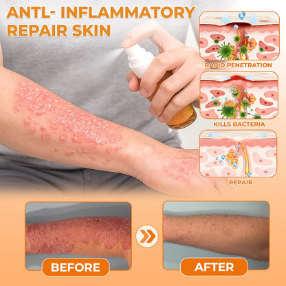 🔥Best Seller🔥Healrize® Bee Venom Antifungal & Antibacterial Spray🎉Special limited-time discount