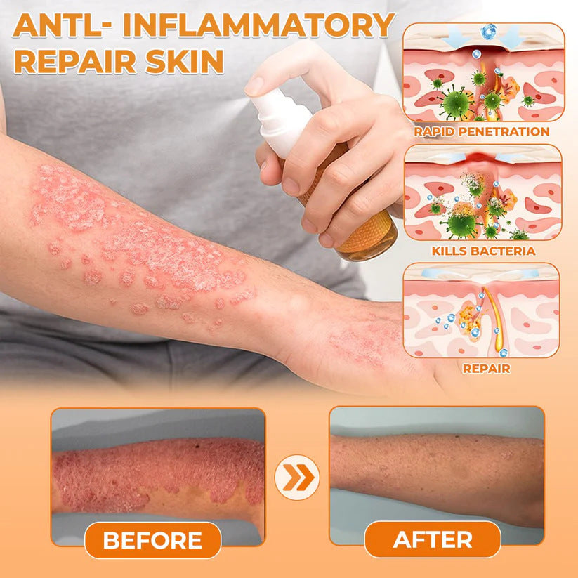 🔥Best Seller🔥Healrize® Bee Venom Antifungal & Antibacterial Spray– Advanced Skin Recovery for Psoriasis & Eczema🎉Special Limited Time 50% OFF